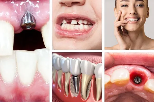 Implant Bridges (1) Implant Bridges 1