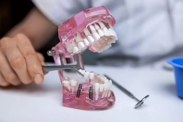 Implant Bridges Implant Bridges