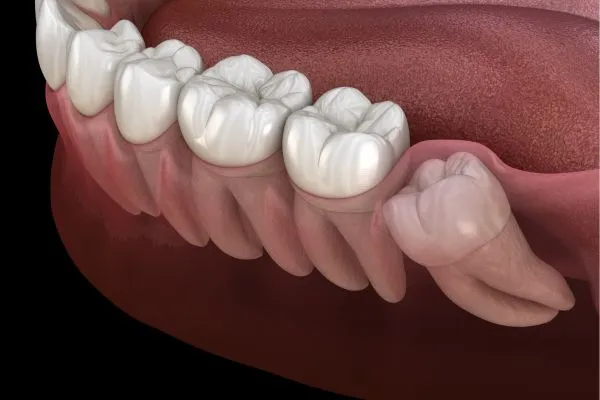 Wisdom Teeth
