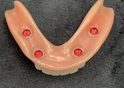 Loose Denture 1