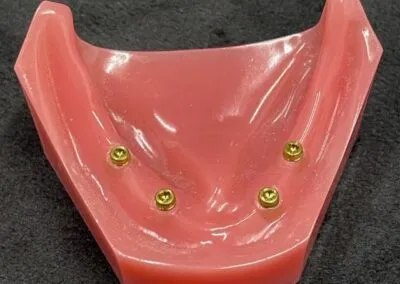 Loose Denture 2