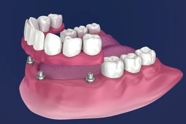Loose Denture