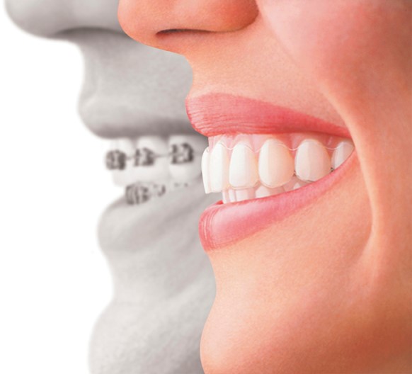 Invisalign® 2 Invisalign® 2