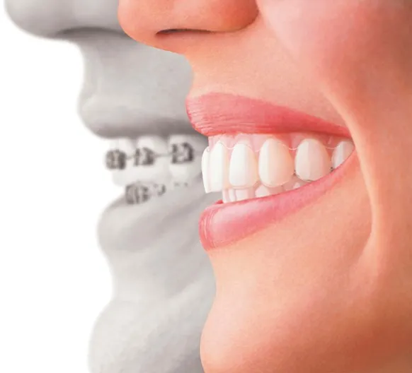 Invisalign® 2